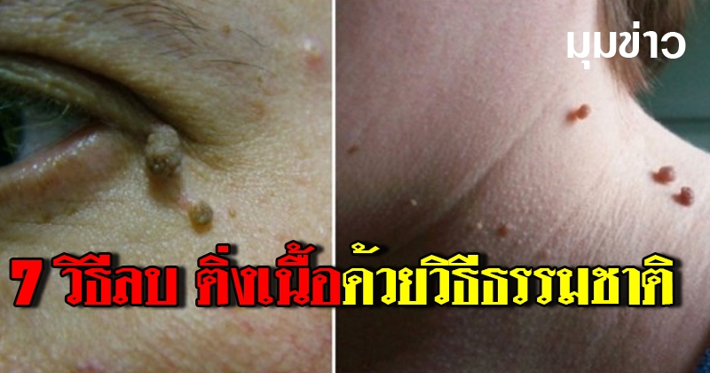 7 วิธีลบ ติ่งเนื้อ ด้วยวิธีธรรมชาติ หาได้ในครัวเรา