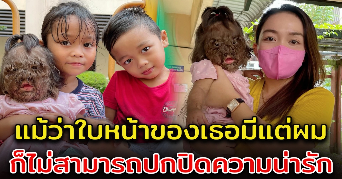 หนูน้อยมีขนดกขึ้นเต็มหน้า แต่ครอบครัวบอก นี่คือของขวัญพิเศษจากพระเจ้า