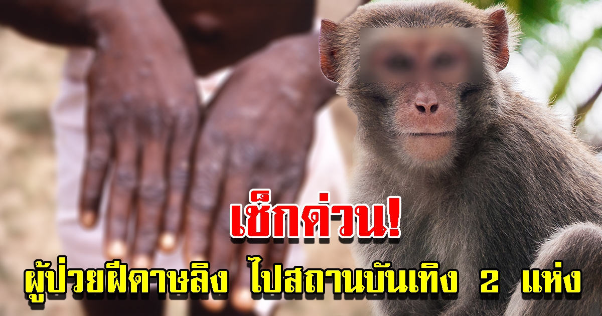 ผู้ป่วย ฝีดาษลิง รายแรกในไทย ไปสถานบันเทิง 2 แห่ง มีสัมผัสเสี่ยงสูง