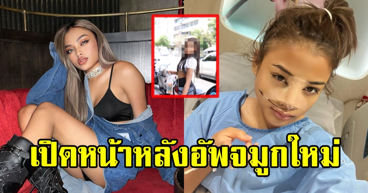 เปิดภาพล่าสุด เนสตี้ สไปรซี่ หลังไปทำจมูกใหม่มาได้ 5 วัน