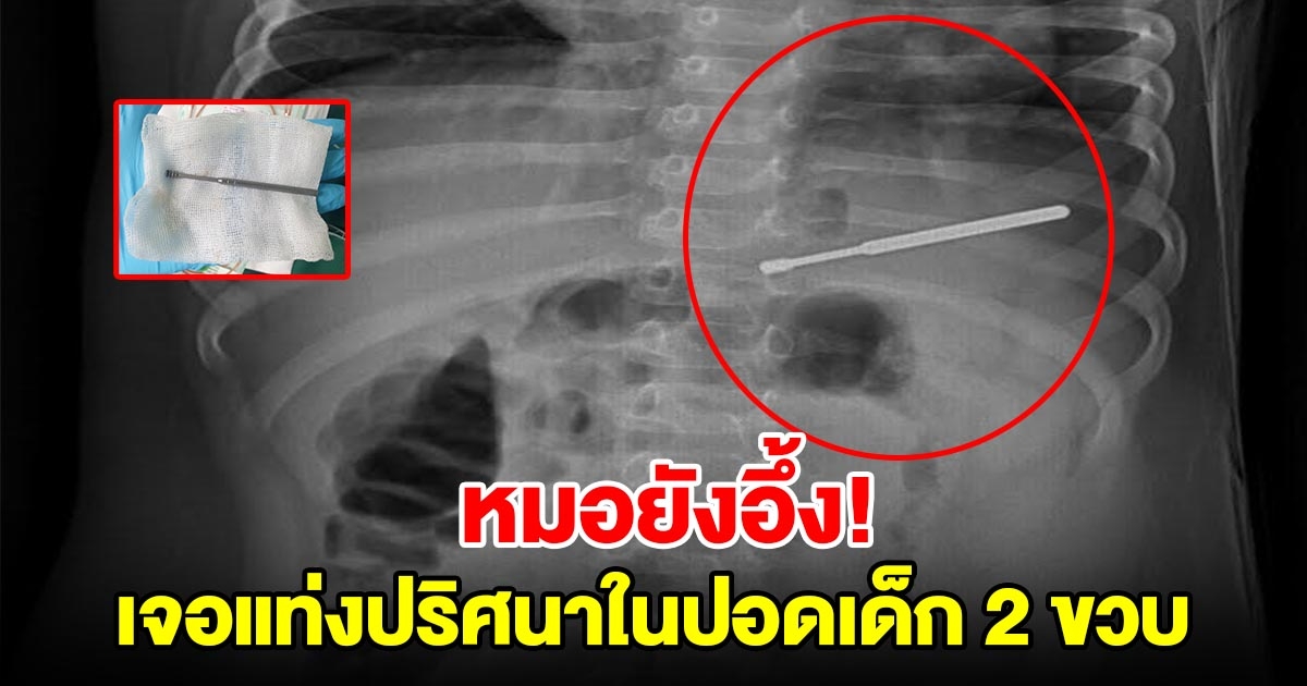 หมอยังอึ้ง เด็ก 2 ขวบมาตรวจปอดบวม เอกซเรย์เจอแท่งปริศนา ชาวเน็ตเฉลยแล้ว