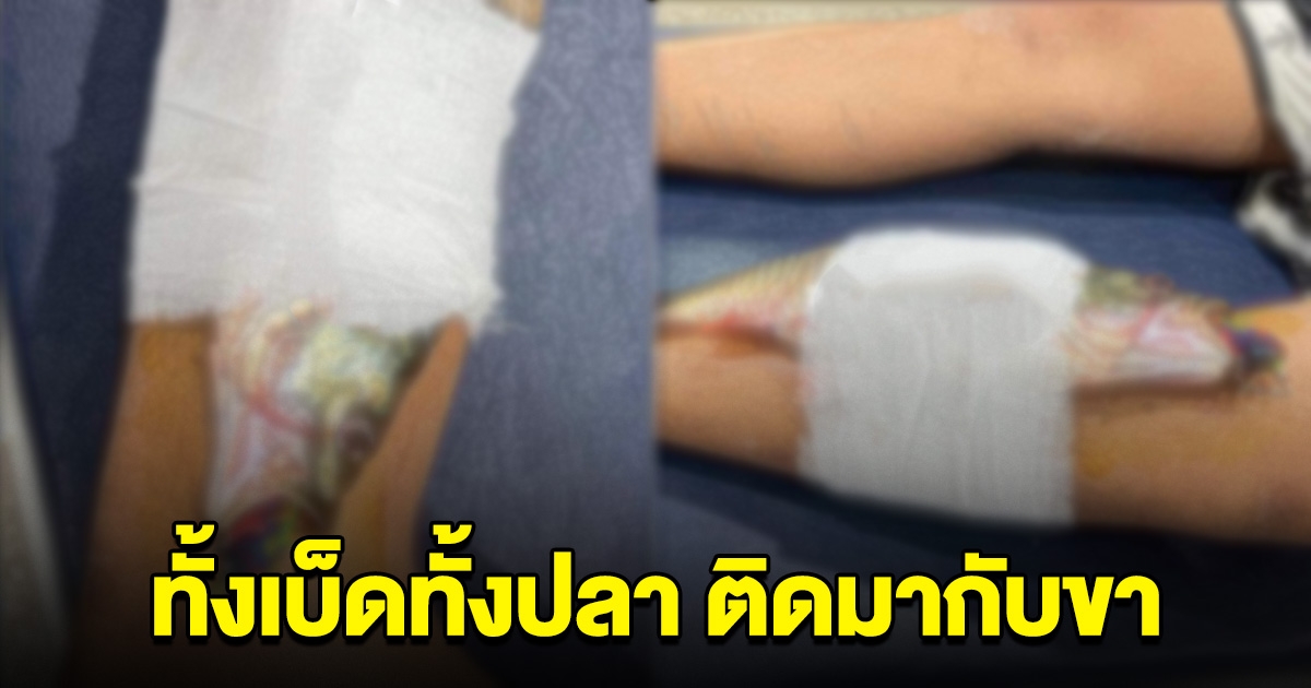 ด.ช. 11 ขวบ ตกปลาได้ ดึงเบ็ดแรงจนถูกปักขา ทั้งเบ็ดทั้งปลาติดมากับขา