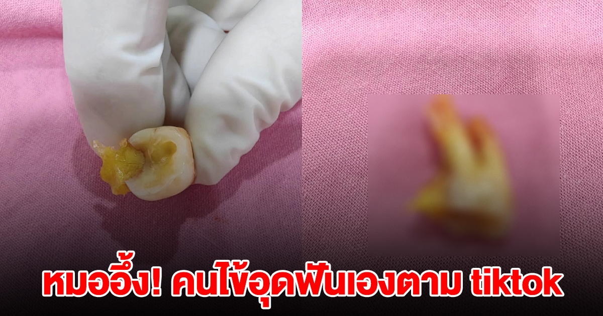 คนไข้ปวดฟัน ไม่ไป รพ. ใช้เจลอุดฟันยี่ห้อดัง ตาม TikTok สุดท้ายงานเข้า