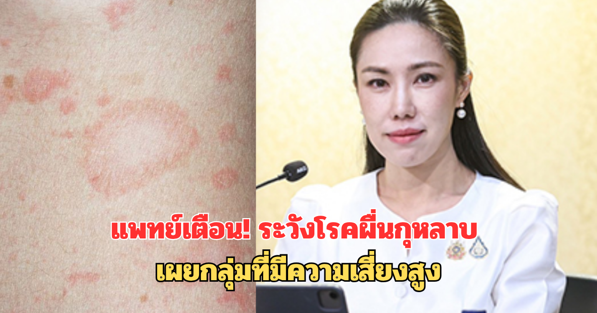 แพทย์เตือน! ระวังโรคผื่นกุหลาบ เผยกลุ่มที่มีความเสี่ยงสูง