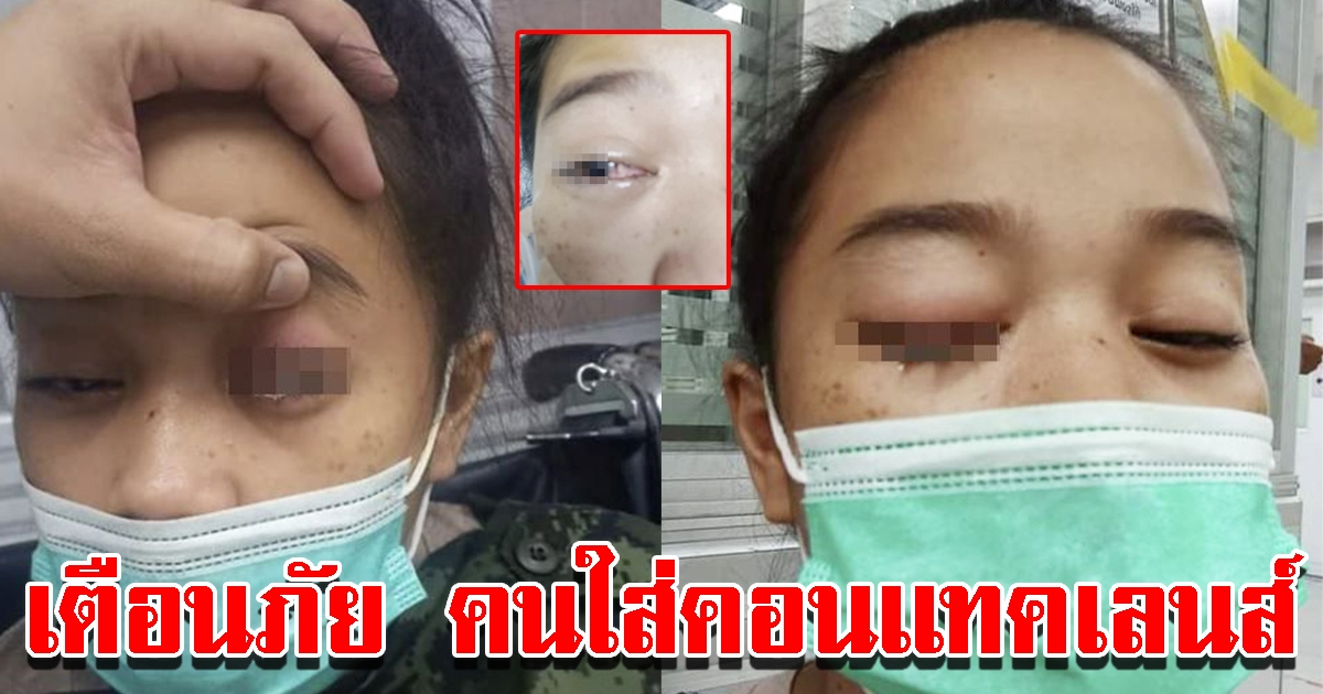 สาวเตือน คอนแทคเลนส์เป็นพิษ ตาเป็นหนองหวิดบอด