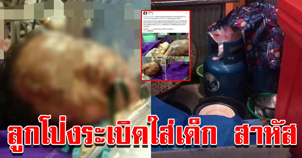 เตือนภัยผู้ปกครอง ลูกโป่งอัดแก๊สระเบิดใส่เด็ก 2 ขวบ เผาร่างไหม้ อาการสาหัส