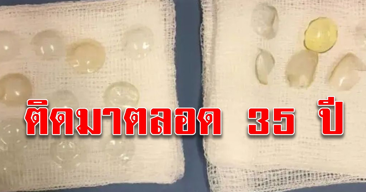 หญิงสูงวัยอายุ67ปี ชาวอังกฤษ ตรวจเจอคอนแทคเลนส์ค้างอยู่ในตา 17 ชิ้น เป็นเวลานานกว่า 35 ปี