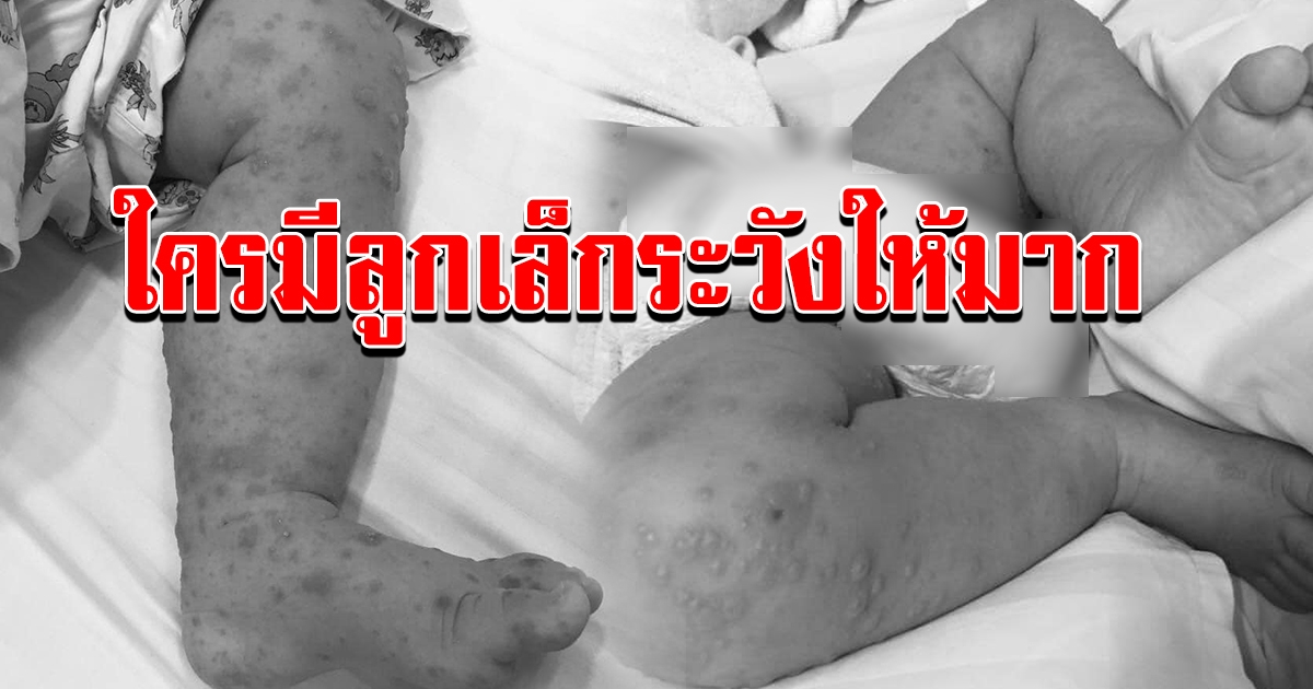 ผู้ปกครองต้องระวังให้มาก โรคมือ เท้า ปาก เริ่มกลับมาระบาด