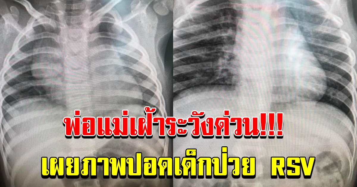 เผยภาพปอดเด็กป่วย RSV ชี้ ไม่มีวัคซีน ไม่มียารักษา เตือน งดจูบ หอม