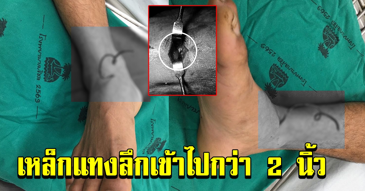อุทาหรณ์ ตัดหญ้าไม่สวมรองเท้าบูท ขณะตัดหญ้าเพลินๆ สุดท้ายความซวยมาเยือนเต็มๆ