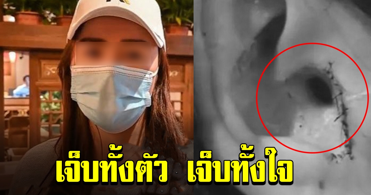 สาวช็อก ทำศัลยกรรมจมูก ฟื้นมาดั้งโด่ง แต่มีบางอย่างหายไป