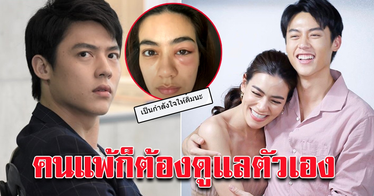 แฟนคลับแห่ส่งกำลังใจ หลัง คิมเบอร์ลี่ โพสต์ภาพตามบวมปูด
