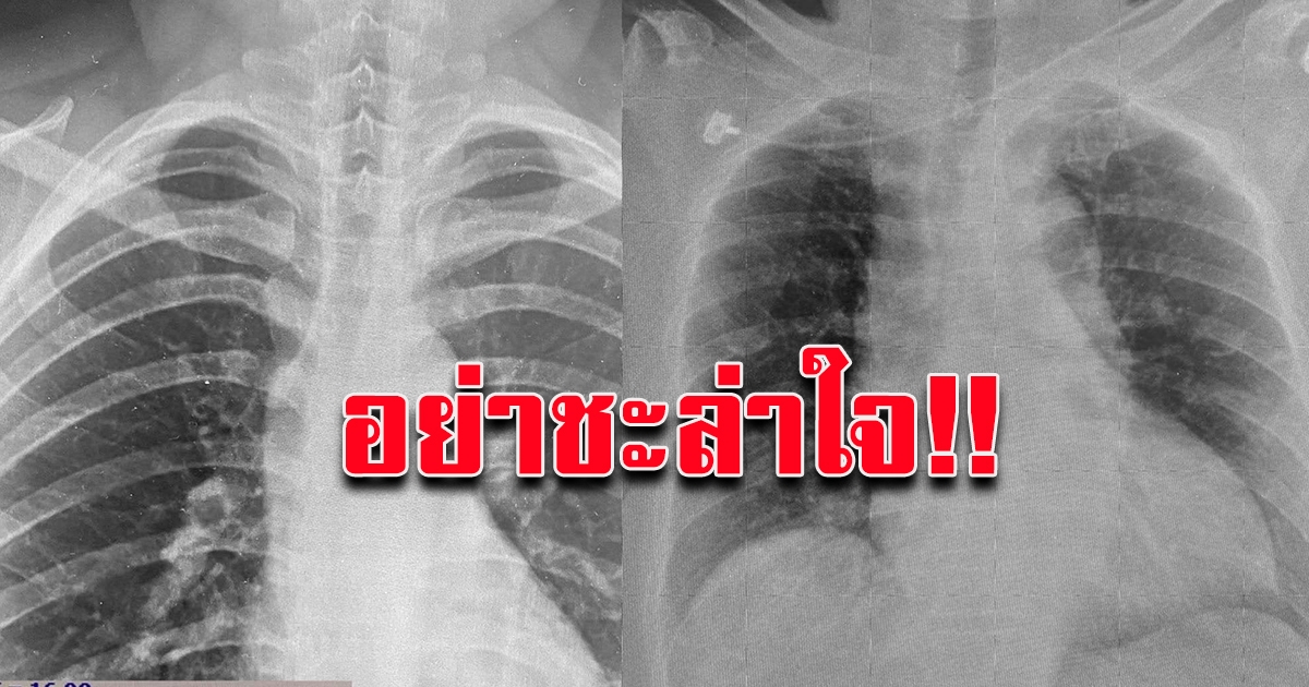อย่าชะล่าใจ เผยภาพเอ็กซเรย์ปอด ป่วยไม่แสดงอาการแต่เชื้อโควิดเพียบ