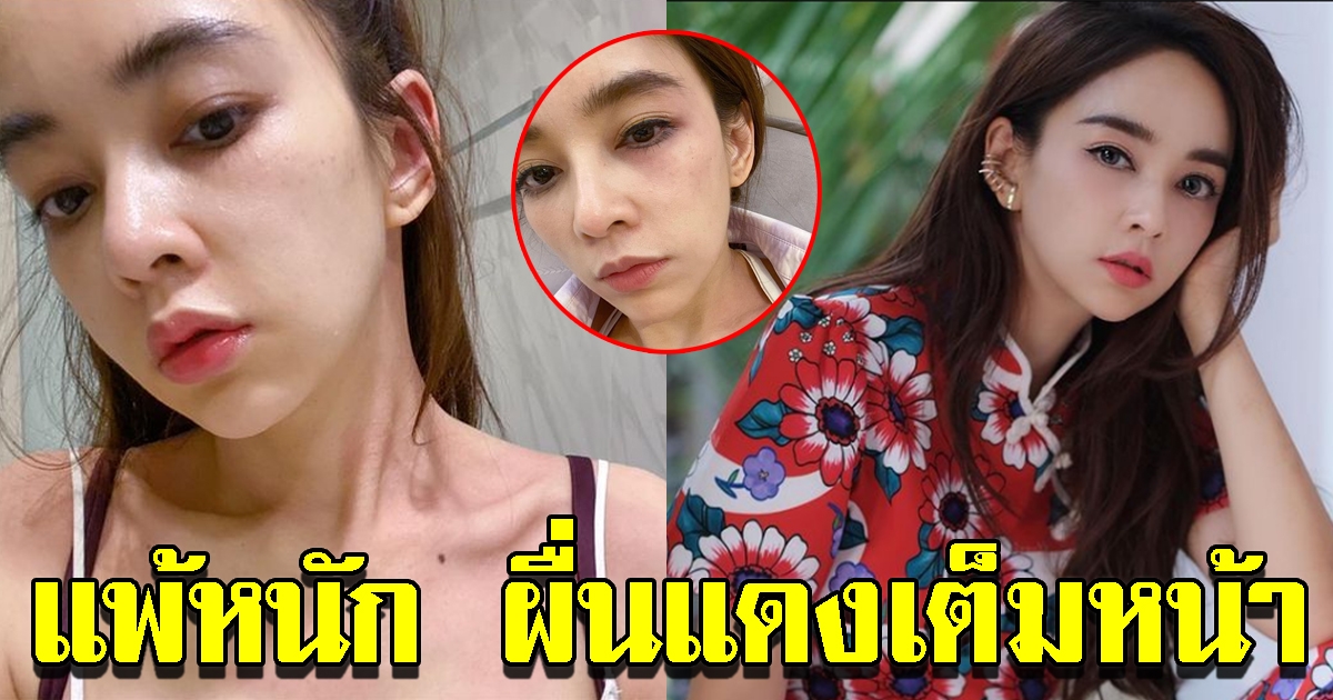 เป้ย ปานวาด เผยภาพแพ้หนัก ผื่นเห่อขึ้นแดงทั้งใบหน้าและตามตัว