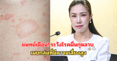 แพทย์เตือน! ระวังโรคผื่นกุหลาบ เผยกลุ่มที่มีความเสี่ยงสูง