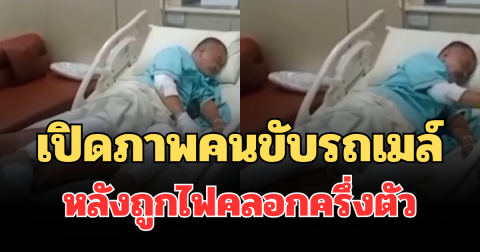 เปิดภาพล่าสุด คนขับรถเมล์ หลังถูกไฟคลอกครึ่งตัว
