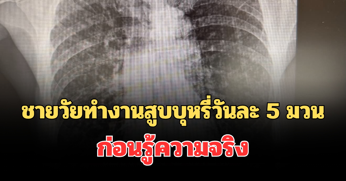 เตือนด่วน!  หมอ เล่าเอง ชายวัยทำงานสูบบุหรี่วันละ 5 มวน ไอเรื้อรัง ก่อนรู้ความจริง