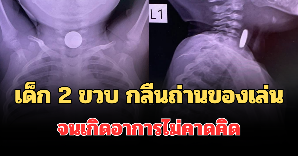 หมอเล่าเอง! อุทาหรณ์เด็ก 2 ขวบ กลืนถ่านของเล่นเข้าไป จนเกิดอาการไม่คาดคิด