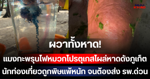 ผวาทั้งหาด! แมงกะพรุนไฟหมวกโปรตุเกสโผล่หาดดังภูเก็ต นักท่องเที่ยวถูกพิษแพ้หนัก จนต้องส่ง รพ.ด่วน
