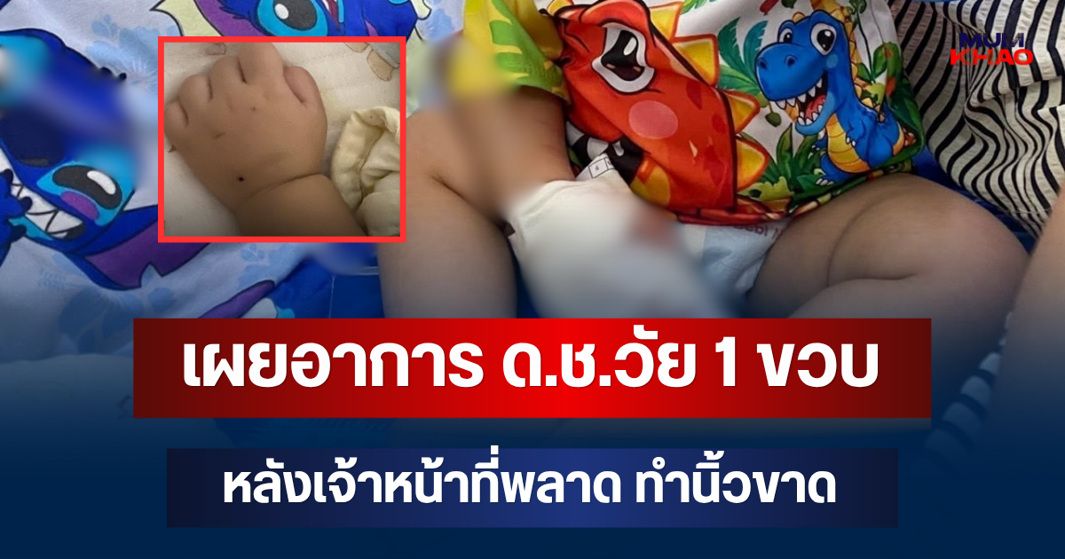 เผยอาการ ด.ช.วัย 1 ขวบ หลังเจ้าหน้าที่พลาด ทำนิ้วขาด